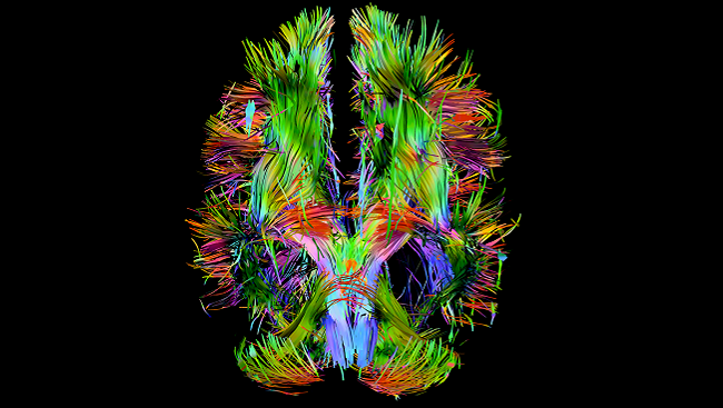 This brain shows lost and irregular connections.