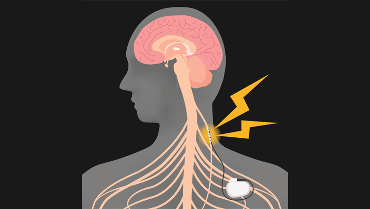 Vagus Nerve Stimulation (VNS) – Caputron