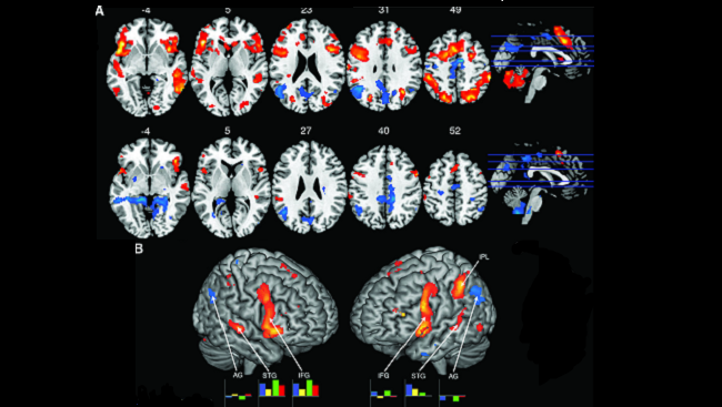 Brain scans comparing the activity of jazz pianists interacting during improvisation show increased activity (red) in the lateral prefrontal cortex and language and sensorimotor areas, and decreased activity (blue) in the angular gyrus.