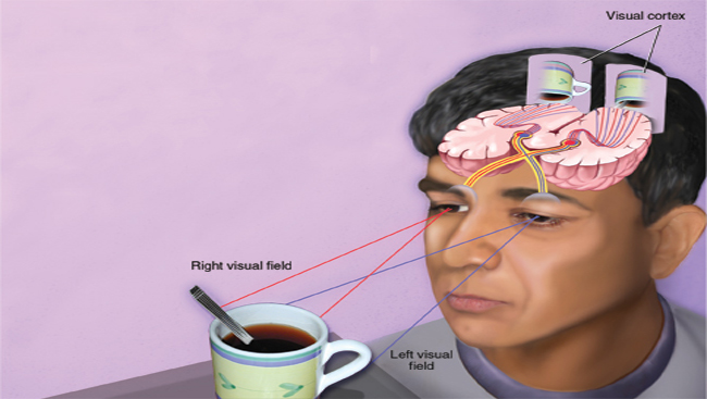 The illustration shows how the brain is wired to integrate visual input from two eyes in order to offer a single, unified view of the world. Scientists discovered blocking one eye in early development leads to physical rewiring of the brain, weakening connections from the deprived eye. 