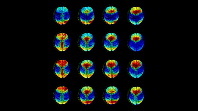 Overlay plots of T1-weighted magnetic resonance images and topographical maps of relative sleep electroencephalography (EEG) power distribution.