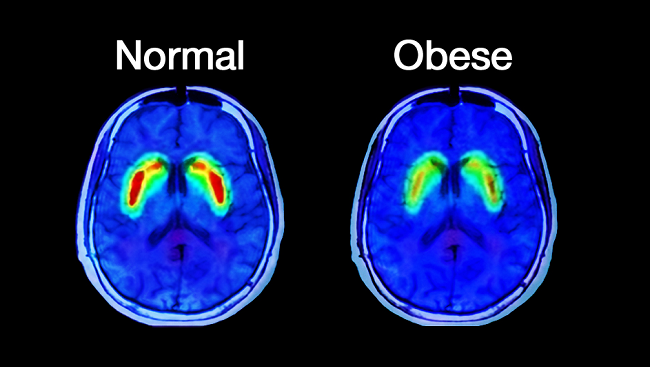 Image result for Brain scan obese people