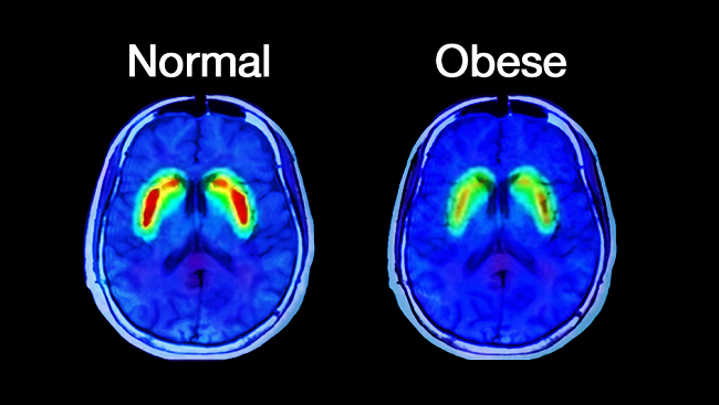In this image, the brain of an obese individual shows fewer dopamine receptors than a control subject. Lower dopamine  levels can increase cravings for fatty foods.