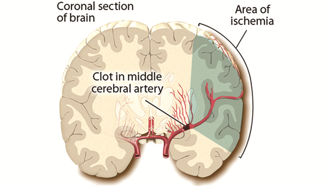 Brain illustration showing stroke area