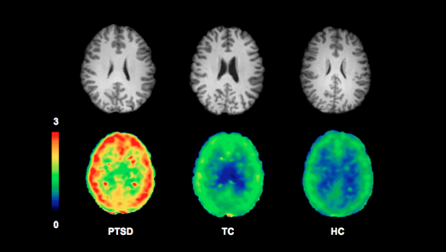 In this image, brightness corresponds to the number of receptors, highlighting the difference between the PTSD brain on the left from the two control brains.