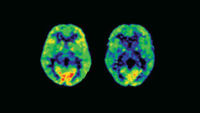 The stress caused by bullying can negatively  affect the developing brain. Stressed animals can show increased levels of corticosterone in the regions of the brain where reward stimuli are processed, increasing the risk for substance abuse.