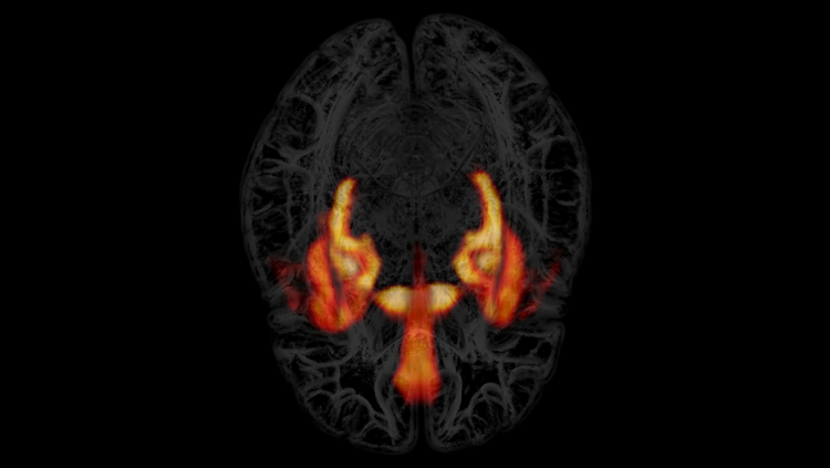 brain with parts lit up orange and yellow