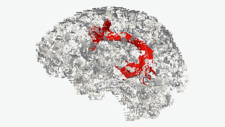 Image of the arcuate fasciculus