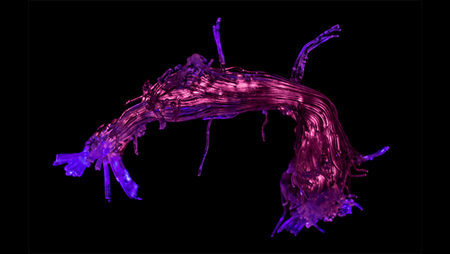 When you talk with a friend, understanding and responding to what they say requires communication between two distant areas of your brain. These areas — one responsible for understanding language and another for producing speech — communicate with each other via a bundle of axons called the arcuate fasciculus, pictured above.