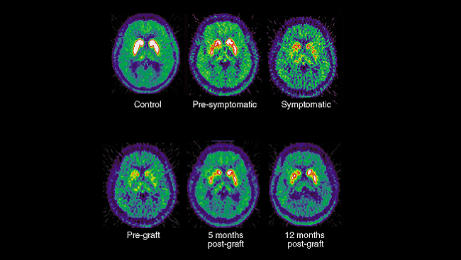 Dopamine and Movement