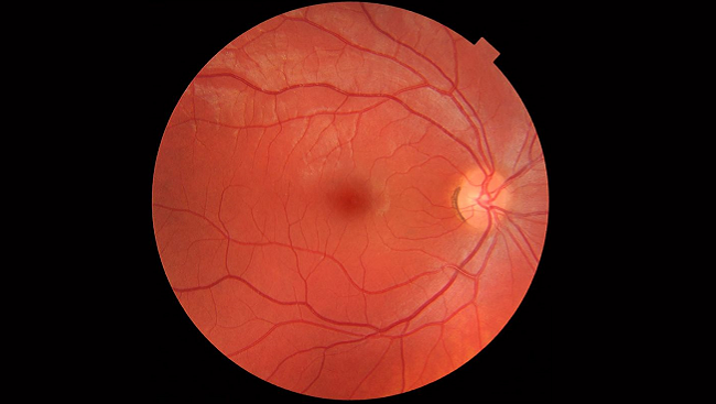 Chart To Check For Macular Degeneration